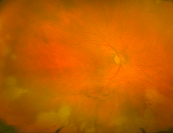 Tratamiento de la necrosis retinal aguda